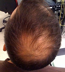 alopecia masculina